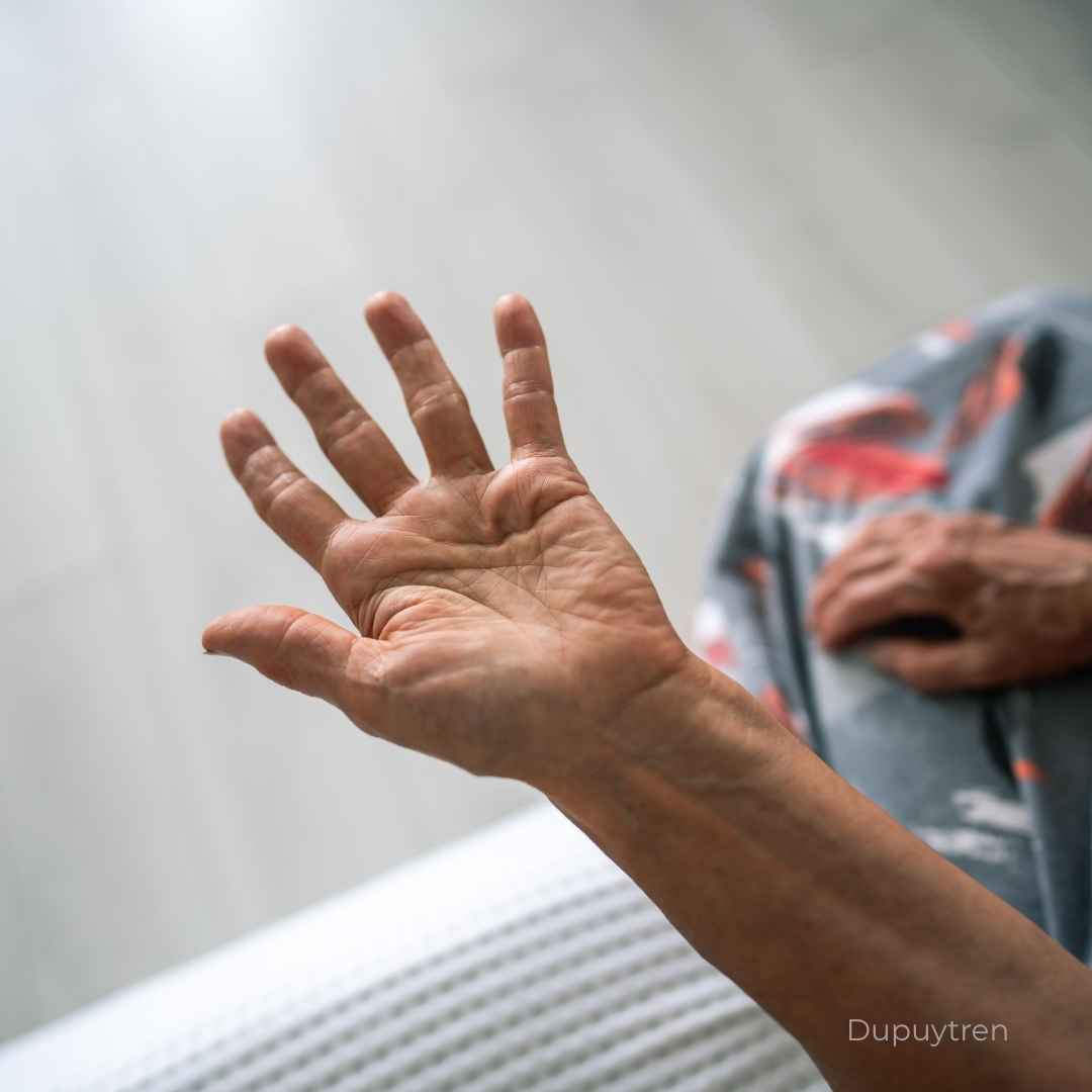 Operație Boala Dupuytren - Tratamentul contracturii palmare