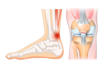 Ruptura de tendon ahilean și rotulian – simptome, diagnostic, tratament