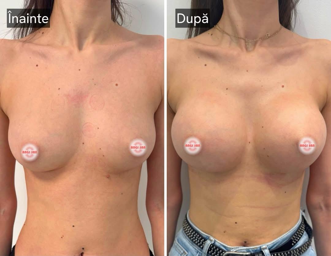 Imagine înainte și după tratament de implant mamar la Clinica Angi San din Buzău,