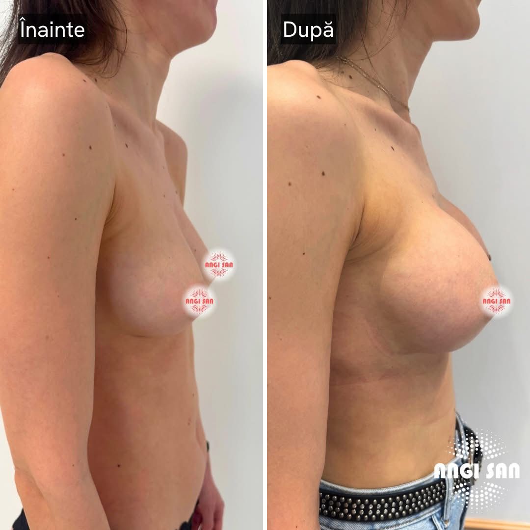 Imagine înainte și după tratament de implant mamar la Clinica Angi San din Buzău