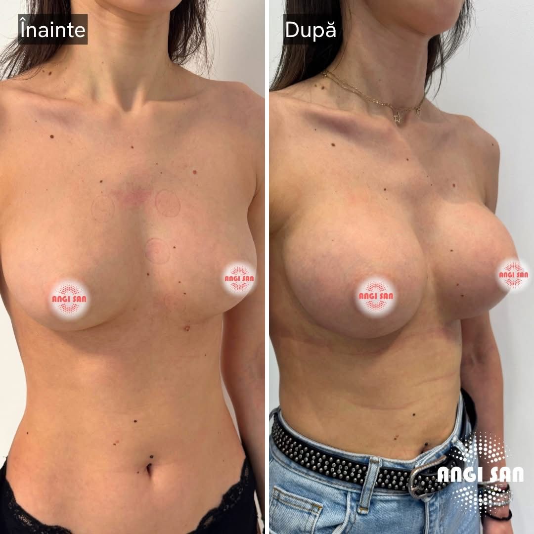 Imagine înainte și după tratament de implant mamar la Clinica Angi San din Buzău