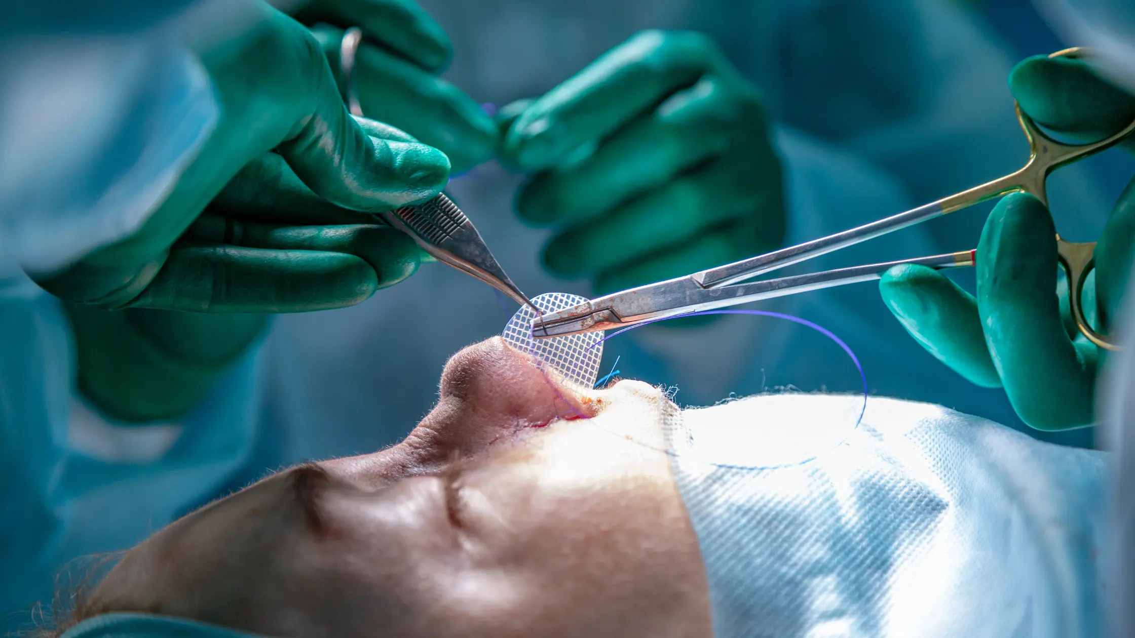 Rinoplastie Nas Borcănat - Soluția Estetică pentru Nasul Borcănat!