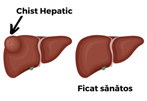chist-hepatic