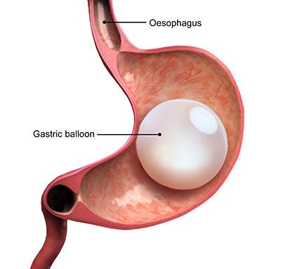 Balon gastric montat