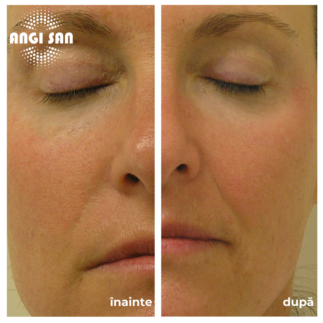 Inainte si dupa tratament Hydrafacial 1