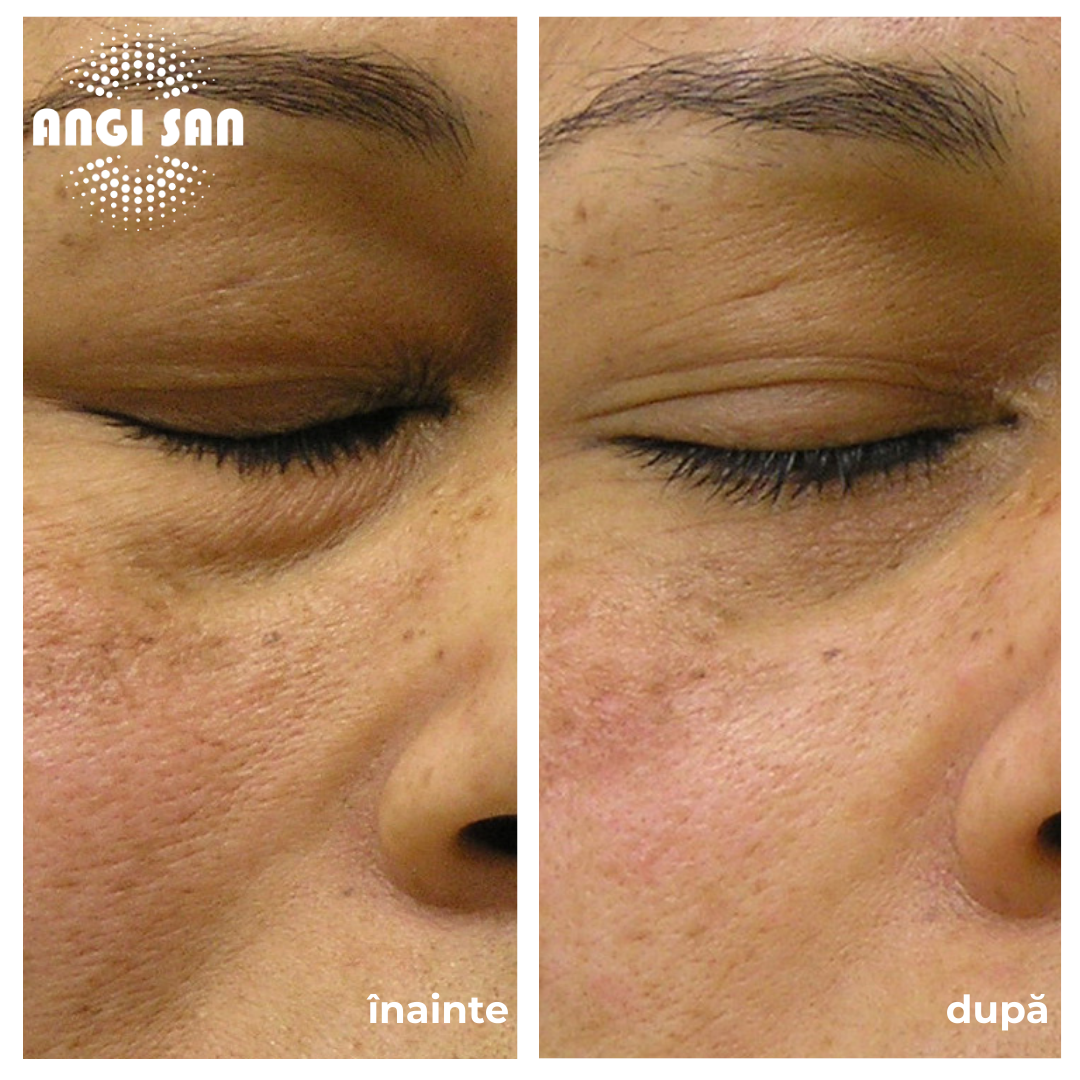 Inainte si dupa tratament Hydrafacial 6