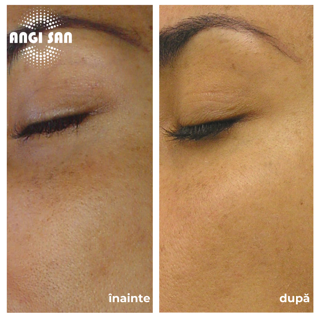 Inainte si dupa tratament Hydrafacial 5