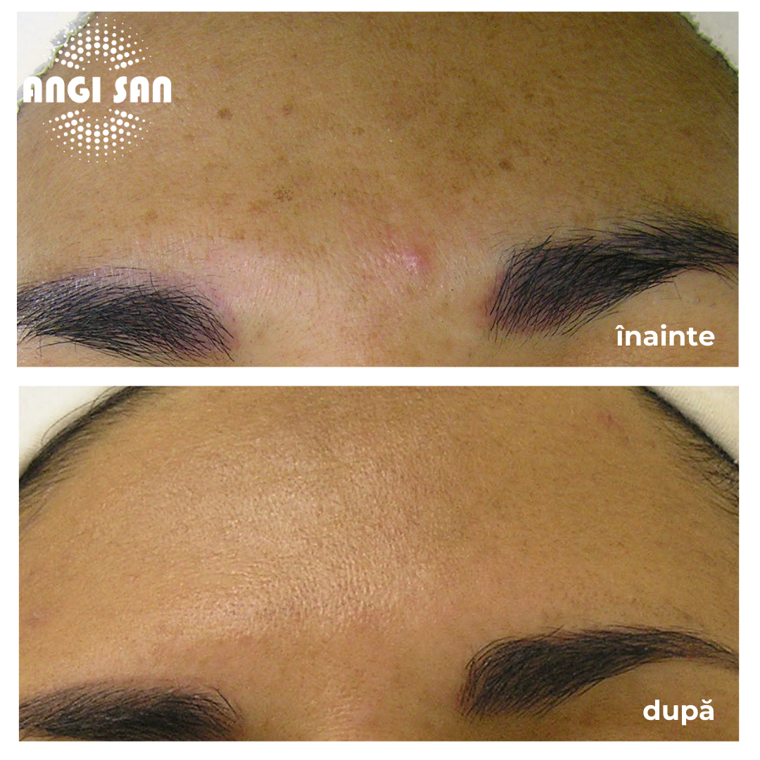 Inainte si dupa tratament Hydrafacial 4