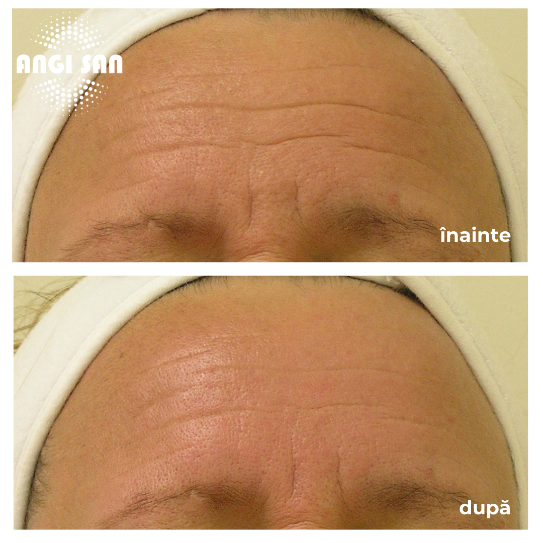 Inainte si dupa tratament Hydrafacial 3